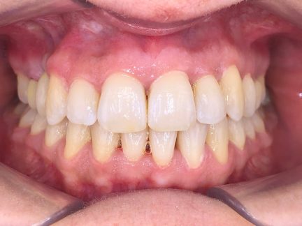 APRES ALIGNEURS APRES ALIGNEURS