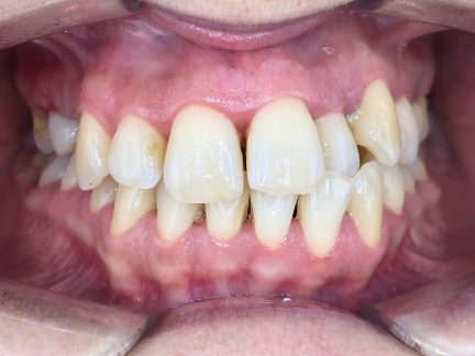 AVANT ALIGNEURS AVANT ALIGNEURS