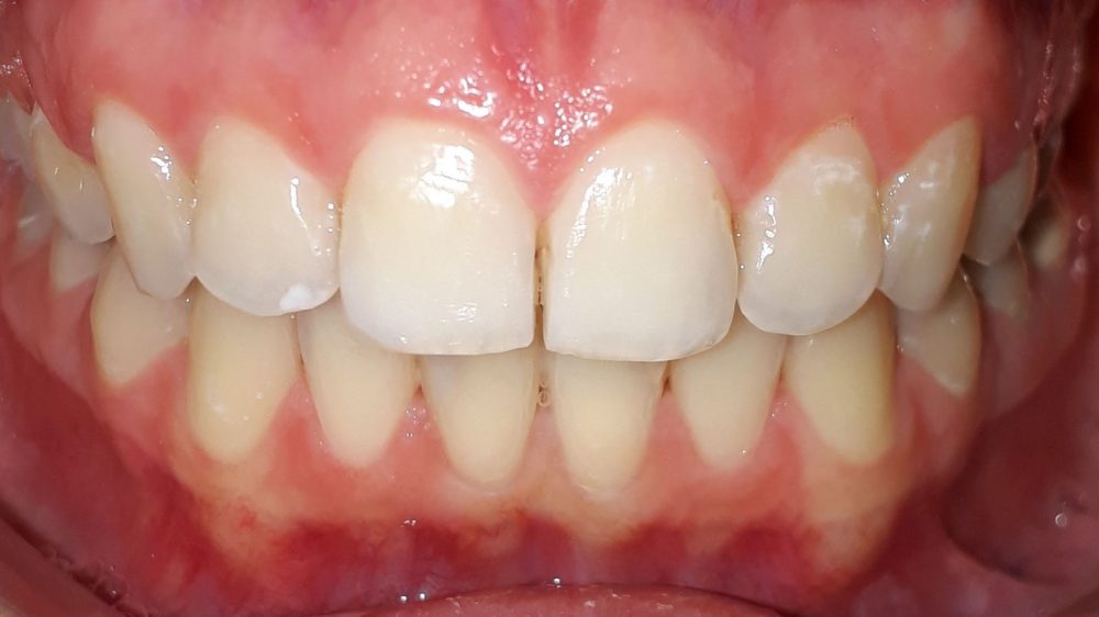 APRES_ALIGNEURS APRES_ALIGNEURS