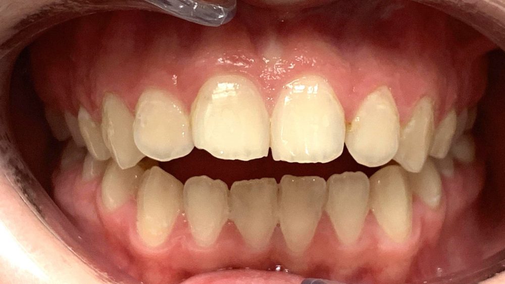 AVANT_ALIGNEURS AVANT_ALIGNEURS