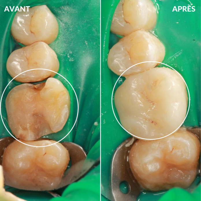 ONLAY-AVANT-APRES ONLAY-AVANT-APRES