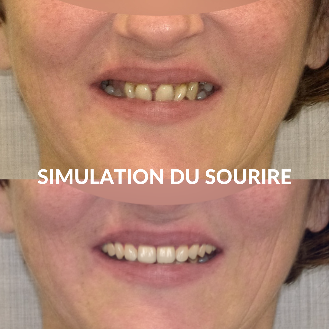 SIMULATION DU SOURIRE SIMULATION DU SOURIRE