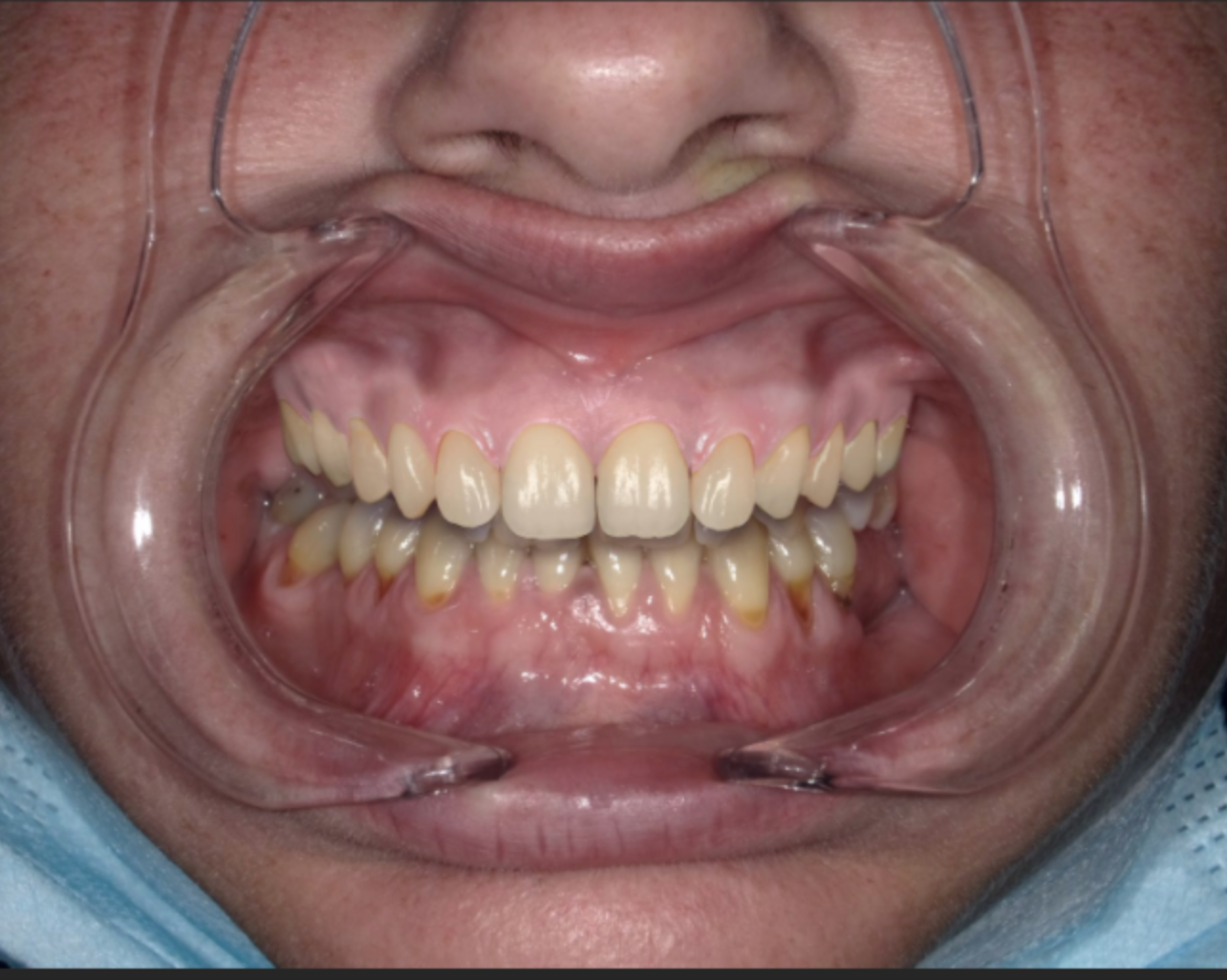 SMILEDESIGN_APRES SMILEDESIGN_APRES