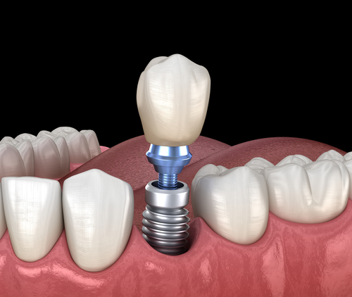 DR-LIVRATI-IMPLANTS-DENTAIRES-2 DR-LIVRATI-IMPLANTS-DENTAIRES-2